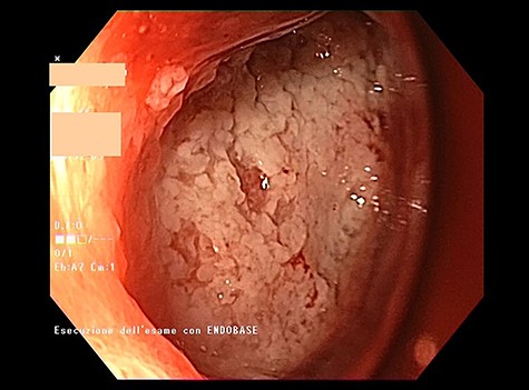 Final endoscopic view of the totally sealed perforated cavity.