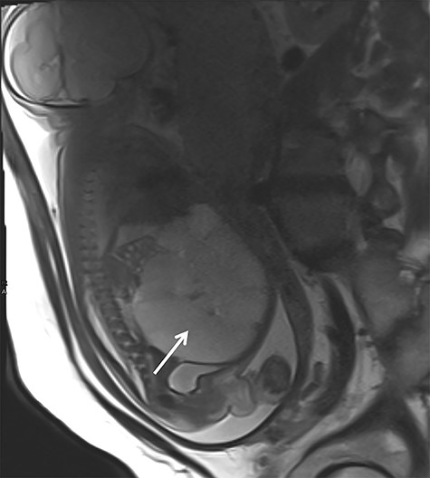 Prenatal MRI in the 29th gestational week showing a multicystic septed mass occupying the complete abdominal cavity (white arrow).