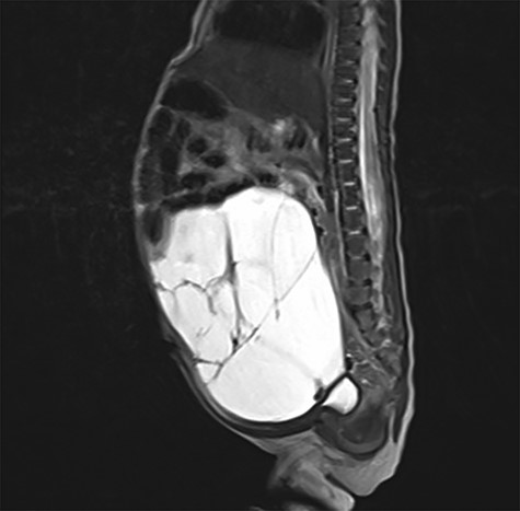 Postnatal abdominal MRI. The bowel loops are displaced into the upper part of the abdomen. The exact origin of the lymphatic malformation could not be described.