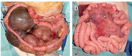 At laparotomy, the lymphatic malformation was limited to the ileocecal mesentery (a), and after complete removal, it was possible to perform an ileocolic termino-terminal anastomosis (b).