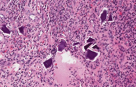 Small bowel biopsy revealing SPS crystals in intestinal mucosa with inflammatory changes.