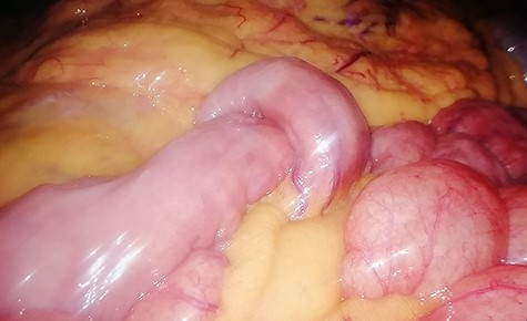 Intraoperative image: jejuno-jejunal intussusception at the level of the second jejunal loop.