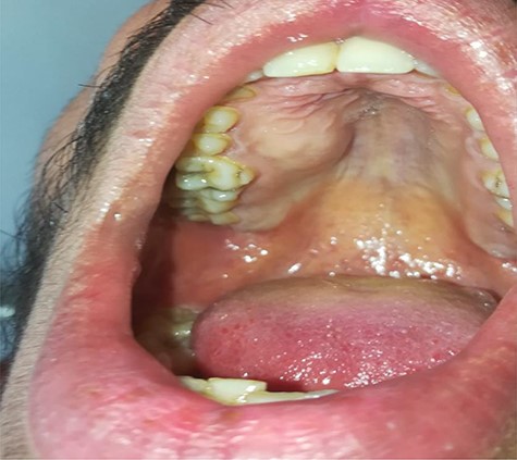 Clinical appearance of the tumor at the time of diagnosis, showing a swelling in the palatine process of maxilla, spreading from the vestibule of the mouth reaching the upper right premolars.