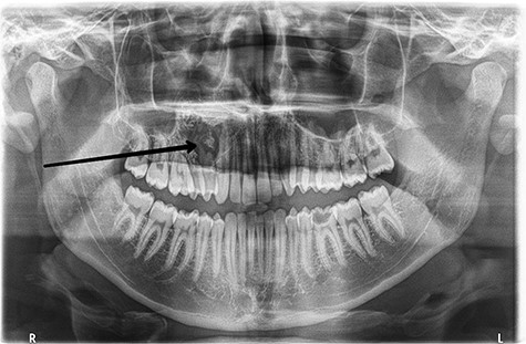 Preoperative orthopantomogram shows the radiolucent area with the calcified lesions in the right hemi-maxilla with resorption in the roots of the upper right premolars.