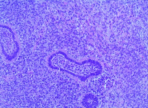 Biphasic tumor composed of islands of benign odontogenic epithelium and an abundant malignant mesenchymal component consisted of ovoid and fusiform cells, in addition to plump and spindle stromal cells that show hyper-cellularity and nuclear polymorphisms associated with cytologic atypia, mitotic figures and anaplasia (hematoxylin-eosin, x40).