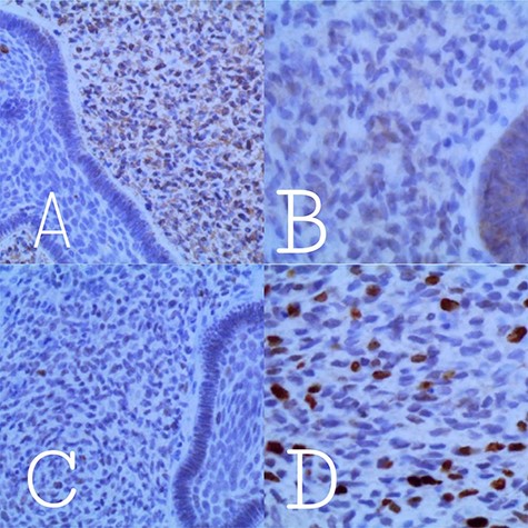 Reactivity to immuno-histochemical stains shows: A: positive reactivity to Vimentin in the mesenchymal component. B: negative reactivity to P53. C: negative reactivity to Bcl2. D: Reactivity to Ki67 in the mesenchymal component with a labeling index of 10–15%.