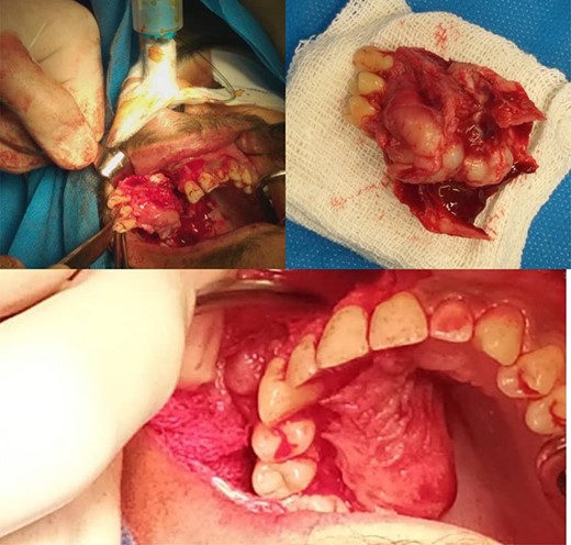 The excised specimen showing an irregularly shaped yellowish gray mass.