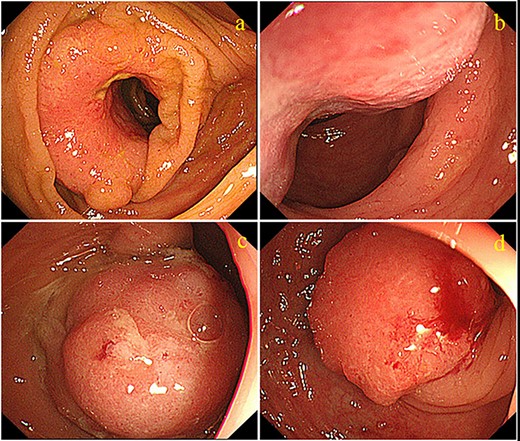 Colonoscopy images showing four tumors. (a) One cauliflower-like tumor with lumen stenosis is located in the ascending colon. (b) Another cauliflower-like tumor is located in the descending colon. The third (c) and fourth (d) tumors are located in the sigmoid colon.