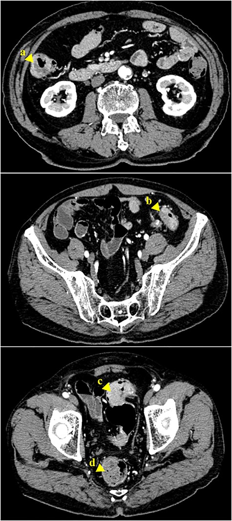 Abdominal CT scan revealing a tumor of the ascending colon (a, arrowhead). A tumor in the descending colon (b, arrowhead), and two tumors in the sigmoid colon are also visible (c, d, arrowhead)