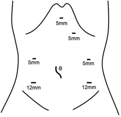 Placement of trocars and mini-incision in the present case