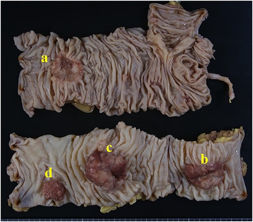 The surgical specimens of the ascending colon cancer (a), descending colon cancer (b) and the two sigmoid colon cancers (c and d).