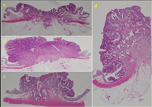 Histopathological examination of the tissue specimens revealed four tumors showing cancerous cells arranged in a tubular pattern.
