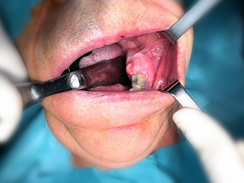 Swelling in the posterior region of the mandible.