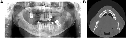 Panoramic radiogram and CT. A panoramic radiogram (A) and a CT (B) revealed the presence of a large and well-delineated radiolucency in the mandible.