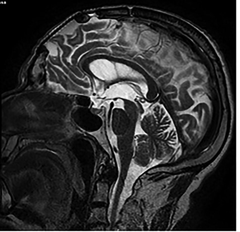 Brain MRI showing titanium cranioplasty without signs of relapse.