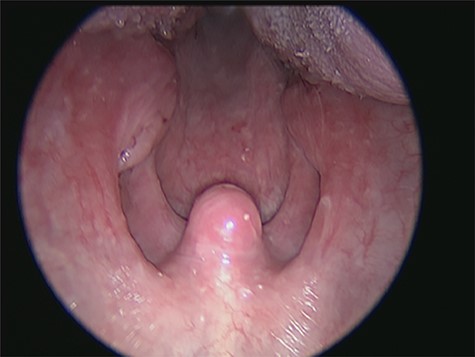 Oropharynx at panendoscopy, showing enlarged left tonsil.