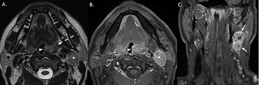(A) T2-weighted axial sequence through the oropharynx, demonstrating asymmetric, exophytic enlargement of the left palatine tonsil (arrowhead). The signal within the middle constrictor is preserved (dashed arrow). An enlarged level II lymph nodal lesion is also noted (asterisk). (B) Axial post-gadolinium fat-suppressed sequence at the same anatomical level demonstrates heterogeneous enhancement of the enlarged let palatine tonsil (arrowhead). The ipsilateral level 2 nodal lesion is also noted (asterisk). (C) Coronal post-gadolinium fat-suppressed sequence demonstrates a conglomerate nodal mass at level 2–3 on the left with areas of central non-enhancement compatible with necrosis.