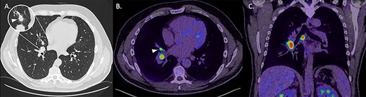 (A) Axial non-contrast CT thorax on lung windows demonstrating a 13-mm, spiculated perihilar lesion within the middle lobe of the right lung (magnified). (B) Axial fused image from a PET-CT demonstrating elevated uptake within the middle lobe lesion (arrowhead) as well as within enlarged ipsilateral hilar lymph nodes. (C) Coronal fused image from a PET-CT demonstrating increased uptake in abnormal right hilar and subcarinal lymph nodes.