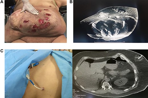 (A): Abdominal hernia, ulcers are seen on the skin. (B): Abdominal CT, multiple loops of bowel in the hernia. (C): Catheter is placed of insufflation.