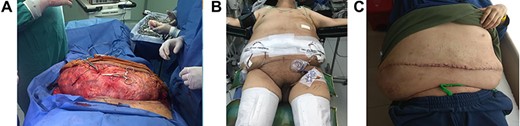 (A): Hernia sac. (B): Patient after surgery. (C): One month after surgery, patient doing well.