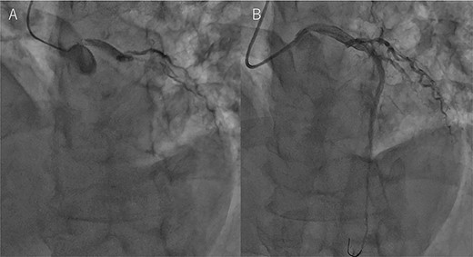 Coronary angiography findings. (A) Pre PCI, the LAD artery was completely occluded. (B) Post PCI, the LAD was recanalized.