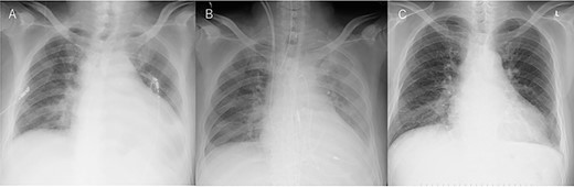Chest X-ray findings. (A) Preoperative, (B) immediately after operation and (C) just after explantation of Impella.