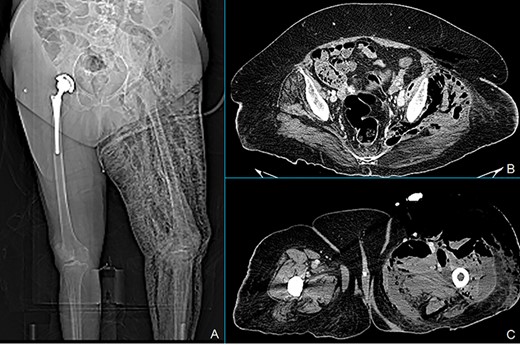 Total body X-ray shows marked left leg emphysema (A). CT scan of the lower abdomen showing covered posterior sigmoid perforation, sigmoid thickening and retroperitoneal collections (B). Marked air and fluid collections in medial and anterolateral compartment of the left leg at the CT scan (C).