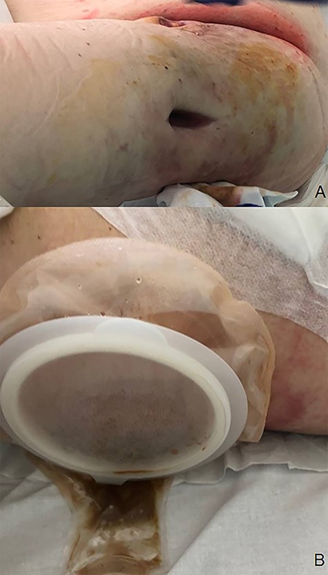Left leg lateral fasciotomy producing fecal material (A). Ostomy bag device used for colocutaneous fistula managing (B).