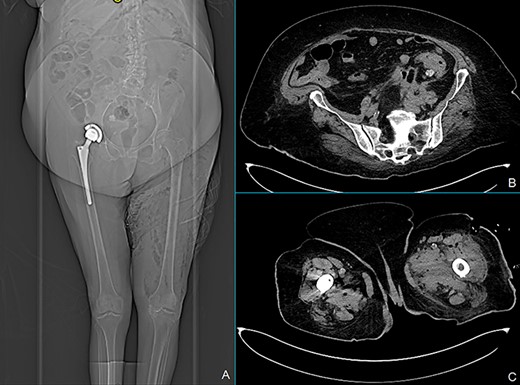 CT scan at the readmission: X-ray showed marked improvement of left leg emphysema (A), a decrease of pericolic abscess (B) and marked reduction of left leg collections (C).