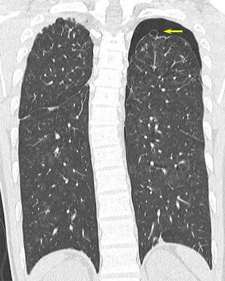 CT scan showing apical bullae on both sides of the upper lobe of the lung and left-sided pneumothorax.