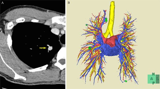 (A) CT scan showing PAVMs in the right upper lung (arrow) and (B) 3D-CT image. Green, PAVM; red, pulmonary artery; blue, pulmonary vein; yellow, trachea and bronchus.