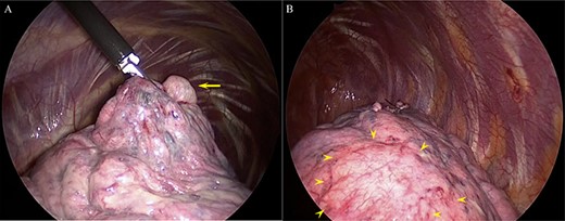 (A) The bullae causing pneumothorax (arrow) and (B) multiple telangiectasias under the visceral pleura (arrowhead).