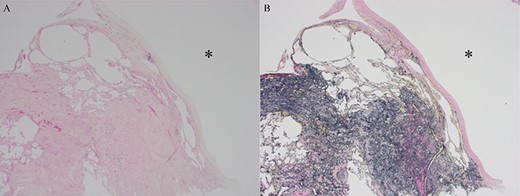 Histopathological findings showing a pulmonary bulla (asterisk in (A) and (B)). (A) Hematoxylin-Eosin stain. (B) Elastica van Gieson stain.