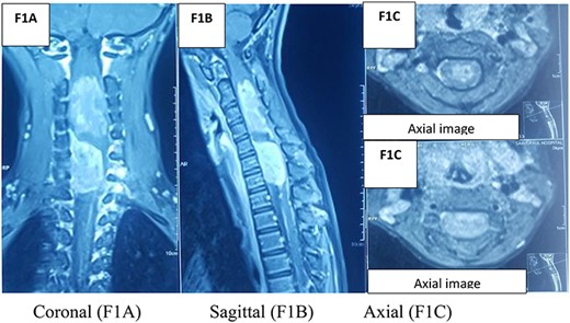 MRI spine.