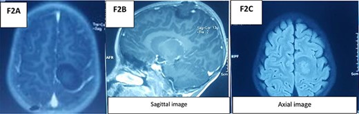 MRI brain.