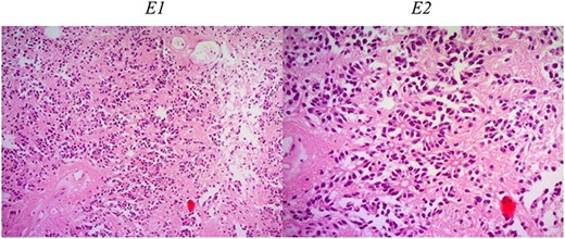Histologic description of ependymoma component. E1 (H&E ×50): moderately cellular with round/oval nuclei having discrete interface with surrounding parenchyma. E2 (H&E ×200): monomorphic cells with salt and pepper chromatin. Key histological features are perivascular pseudorosettes and ependymal rosettes.