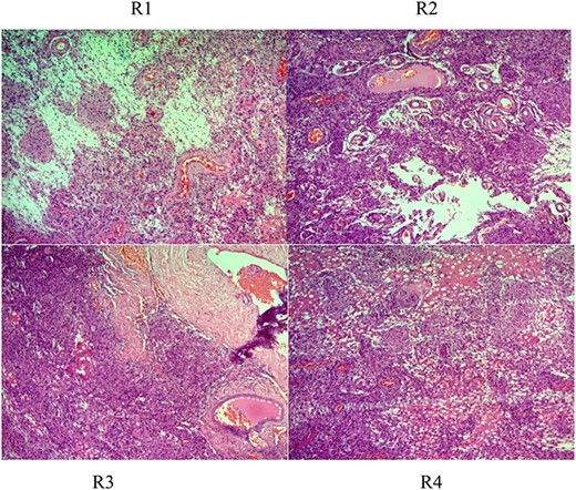 Histologic description of rhabdoid meningioma (brain) (WHO Grade II). R1–4 (H&E ×50, ×100, ×200): sheets of loosely cohesive cells with clear nuclei and pleomorphism, retaining meningothelial features (whorl formation).