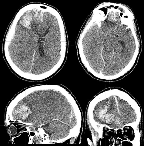 CT brain scan showing massive right frontal ICH causing significant mass effect and transtentorial herniation (superior left and inferior right). There is also moderate vasogenic edema (superior and inferior left). The mass extends to the floor of the anterior cranial fossa (superior right and inferior left).