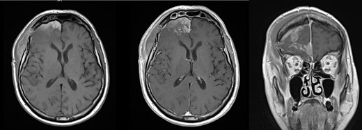 Axial pre- (left) and post-contrast T1-weigted MRI brain (middle) showed relief of the mass effect with correction of the midline shift. Coronal image (right) confirmed residual tumor along the right of the falx cerebri.