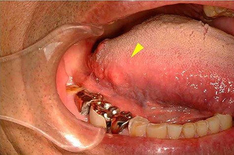 Intra-oral photograph showing the tumour of the tongue (arrowhead).