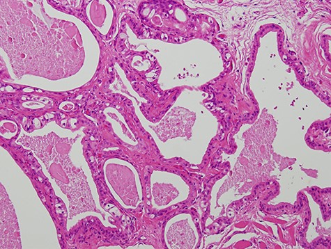 Micrograph showing the lesion composed of multiple cysts of various sizes and shapes (haematoxylin–eosin stain, 100×).