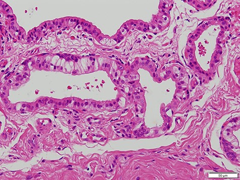Micrograph showing the cystic cavities lined by a bilayered epithelium (haematoxylin–eosin stain, 200×).