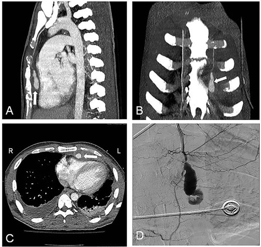 Contrast-enhanced CT with LIMA pseudoaneurysm (white arrow). (A) Sagittal plane; (B) coronal plane; (C) transverse plane with LIMA pseudoaneurysm (white arrow) and bilateral pleural effusions; (D) selective LIMA angiography demonstrating the aneurysm.