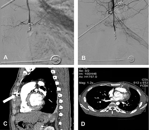 (A) Coil embolization of the aneurysm; (B) postembolization completion angiogram; (C) follow-up contrast-enhanced CT scan at 3 weeks after the embolization with complete regression of the pseudoaneurysm without flow into it (white arrow); (D) follow-up contrast-enhanced CT scan at 6 months after the embolization.