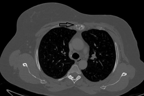 Lytic mid-sternal lesion on CT (arrow).