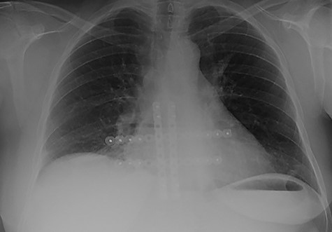 Follow-up chest radiograph demonstrating the fixation plates.
