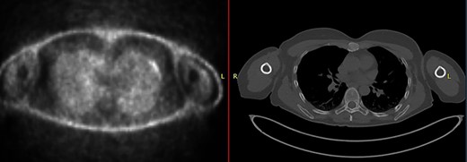 CT–PET demonstrating increased metabolic activity within the sternal lesion.