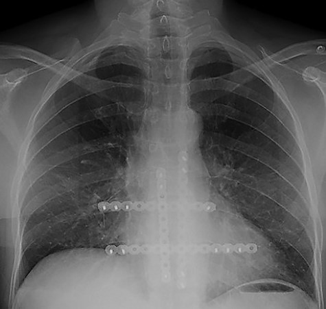 Follow-up chest radiograph of second patient.