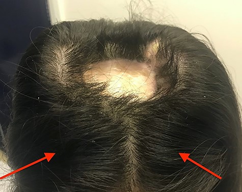 Clinical photograph taken after implantation of tissue expanders– a 7 × 6 cm ovoid soft tissue defect initially reconstructed using split thickness skin grafting can be seen at the mid-scalp; red arrows indicate port sites that were placed, anterior to the expander to avoid inadvertent damage during expansion, rectangular tissue expanders were sited laterally to the mid-scalp defect and inflated to a total volume of 140 ml before tissue expander removal.
