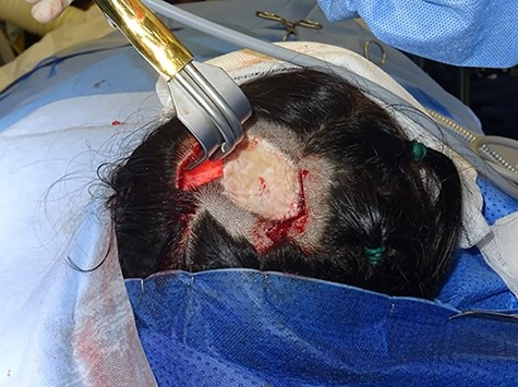 Intraoperative photograph taken during tissue expander insertion demonstrating dissection of the soft tissue pocket through a remote incision with the assistance of a lighted retractor.